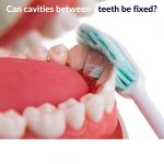 cavities between teeth